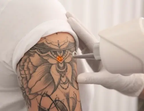 Se você tem uma tatuagem que não representa mais quem você é, a remoção de tatuagem a laser é a solução mais moderna, segura e eficaz disponível atualmente. Utilizando tecnologia de ponta, o tratamento permite remover totalmente ou clarear a tatuagem para uma nova cobertura, respeitando a saúde da pele e proporcionando resultados progressivos e naturais.